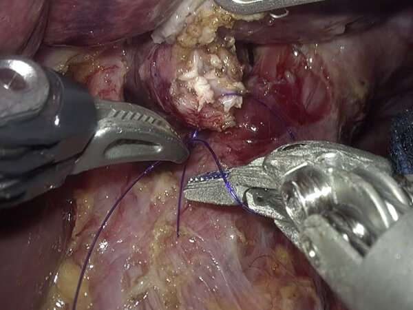 ロボット支援胃切除（hinotori使用例）1
