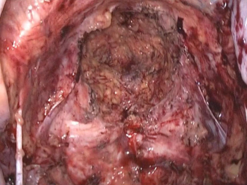 【図4】骨盤内臓全摘術（腹腔鏡）