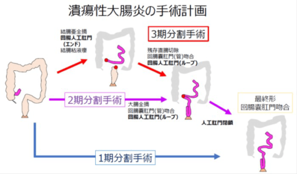 【図6】潰瘍性大腸炎の手術計画